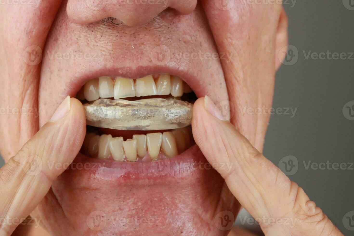 Older Mature Man putting in a night Guard in his mouth to prevent grinding photo