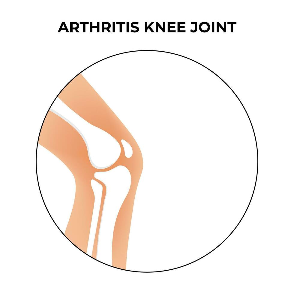 artritis rodilla articulación Ciencias diseño vector ilustración