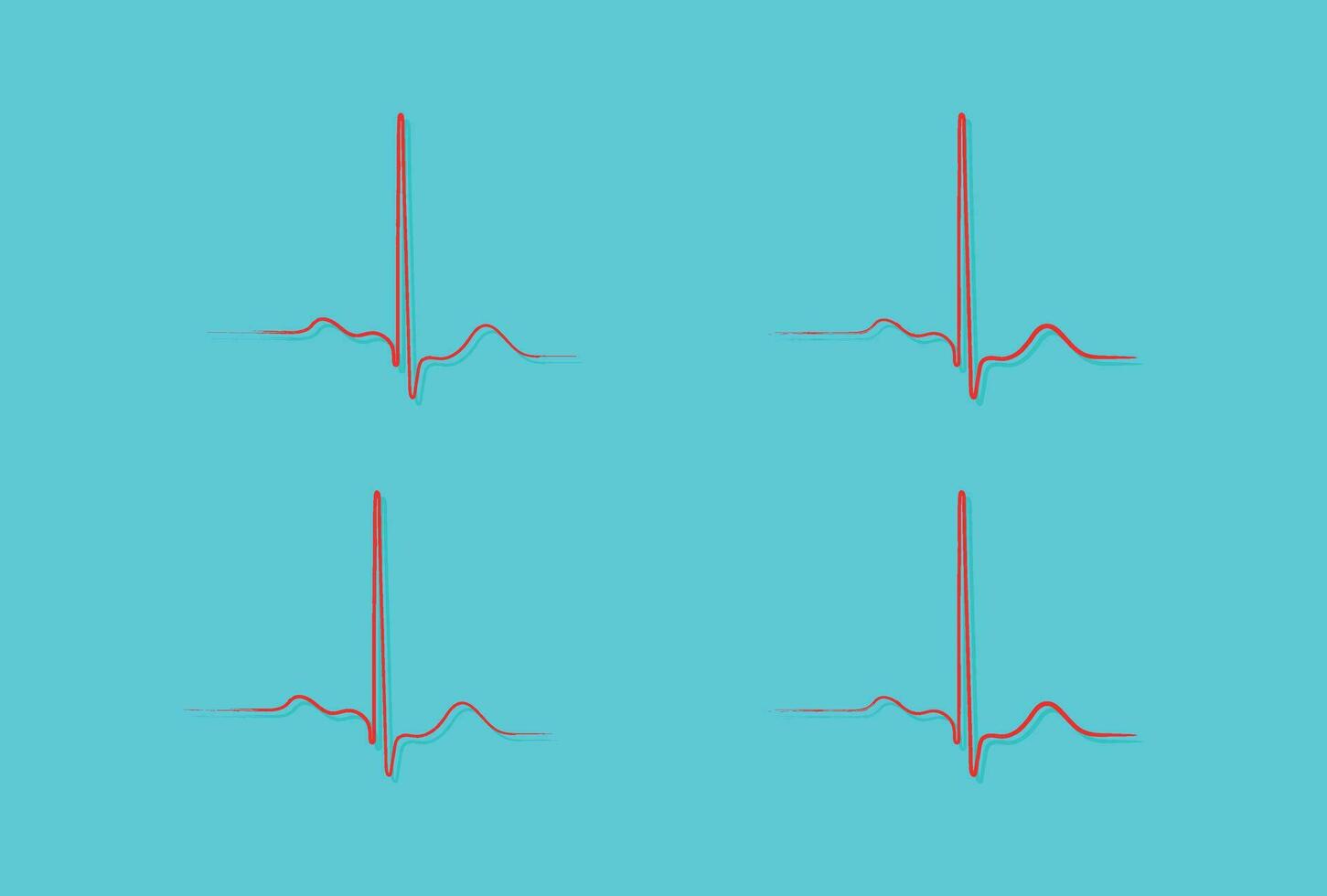 Ventricular repolarization, Cardiac cycle, ECG of heart in normal sinus rhythm, QT interval of ECG. vector