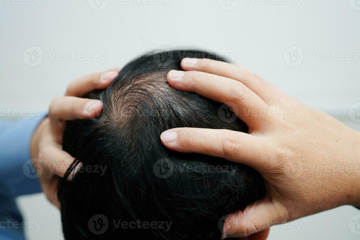 Bald head in man, hair loss treatment health problem. photo