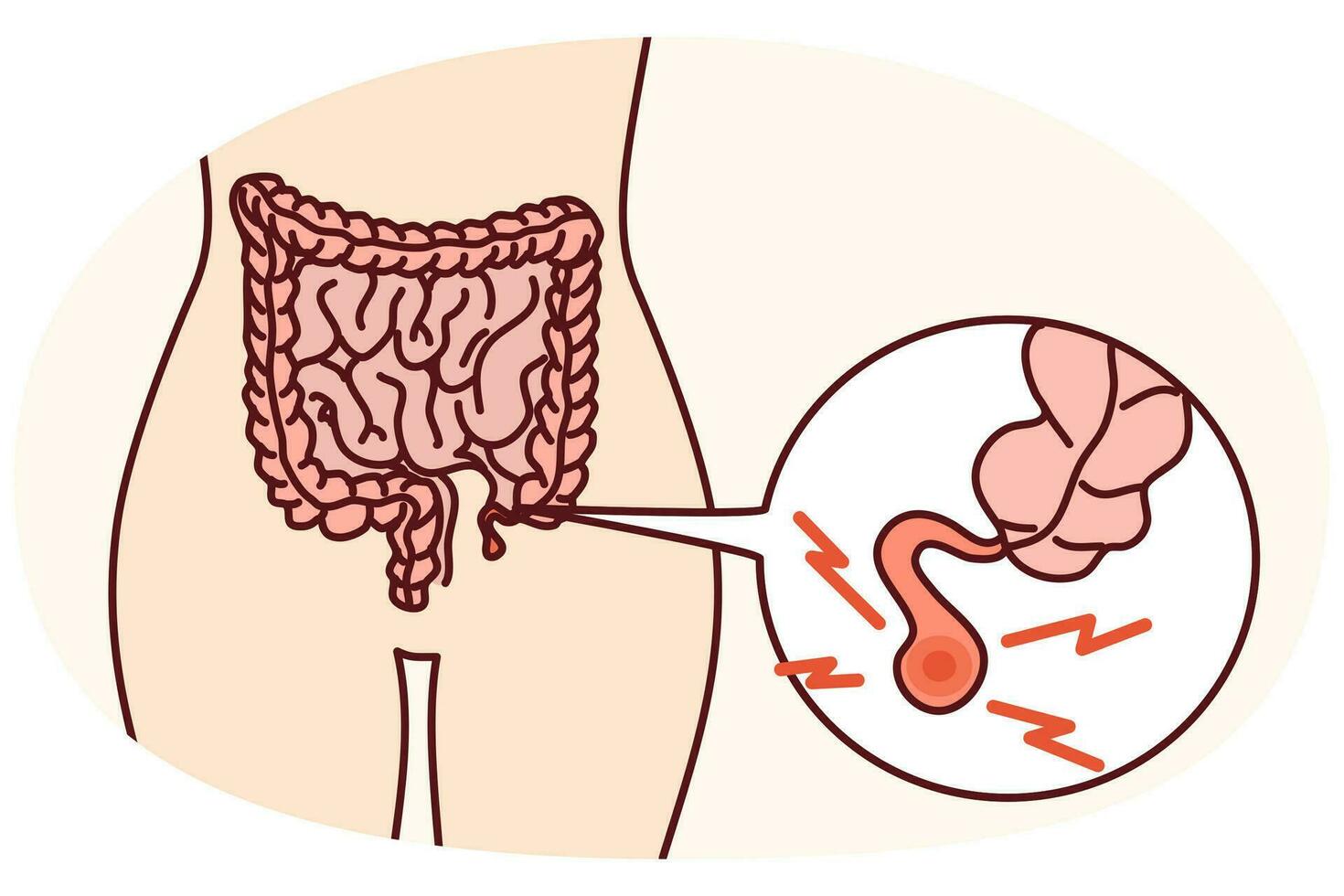 Closeup of human body with inflamed appendix. Person suffer from appendicitis need surgery. Vector illustration.