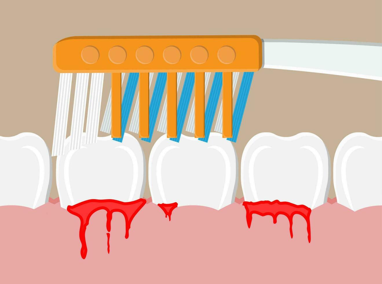 cepillo de dientes limpia dientes. periodontal enfermedad, sangrado cena. cepillado dientes. dental equipo. higiene y cuidado bucal. vector ilustración en plano estilo