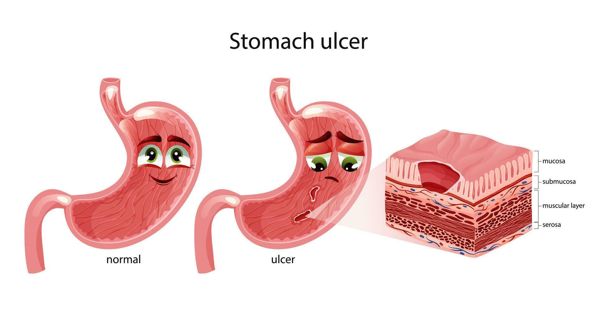 Stomach ulcers. Cute happy and sad stomach characters with faces