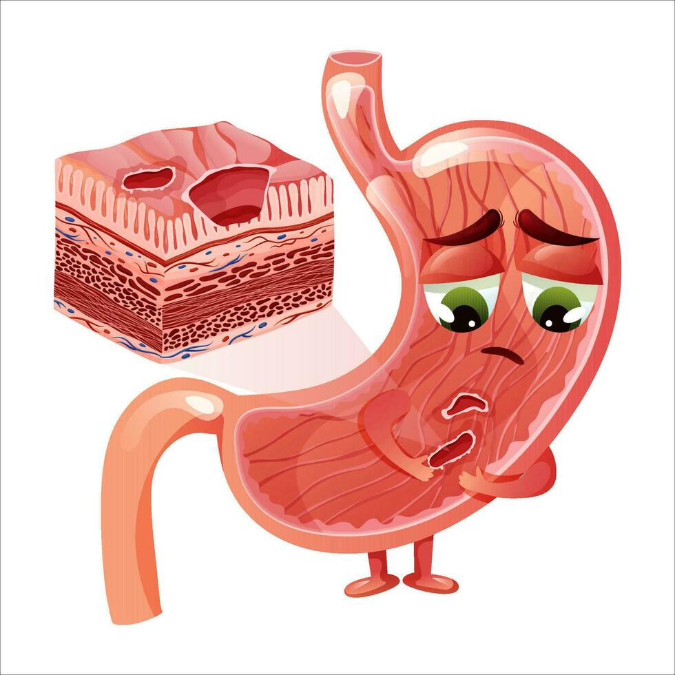 Stomach ulcers. Cute and sad stomach character with face and two ulcers. Stomach cross section diagram. Anatomical vector illustration