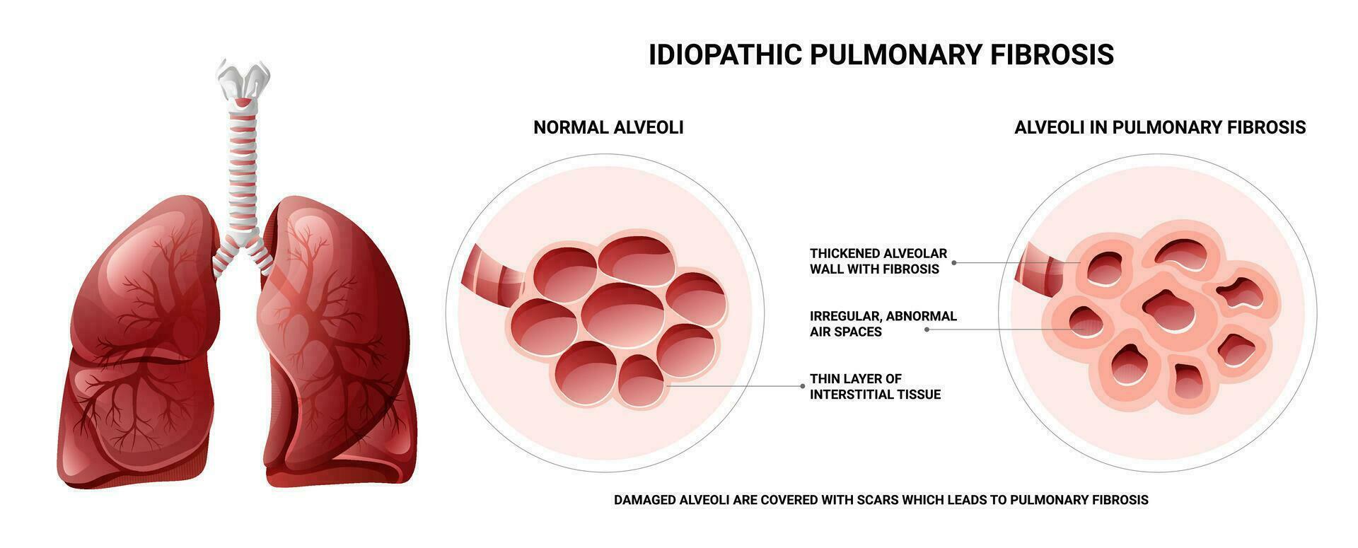 Pulmonary fibrosis and normal lung tissue differences infographic. Vector illustration isolated on white background, cartoon style