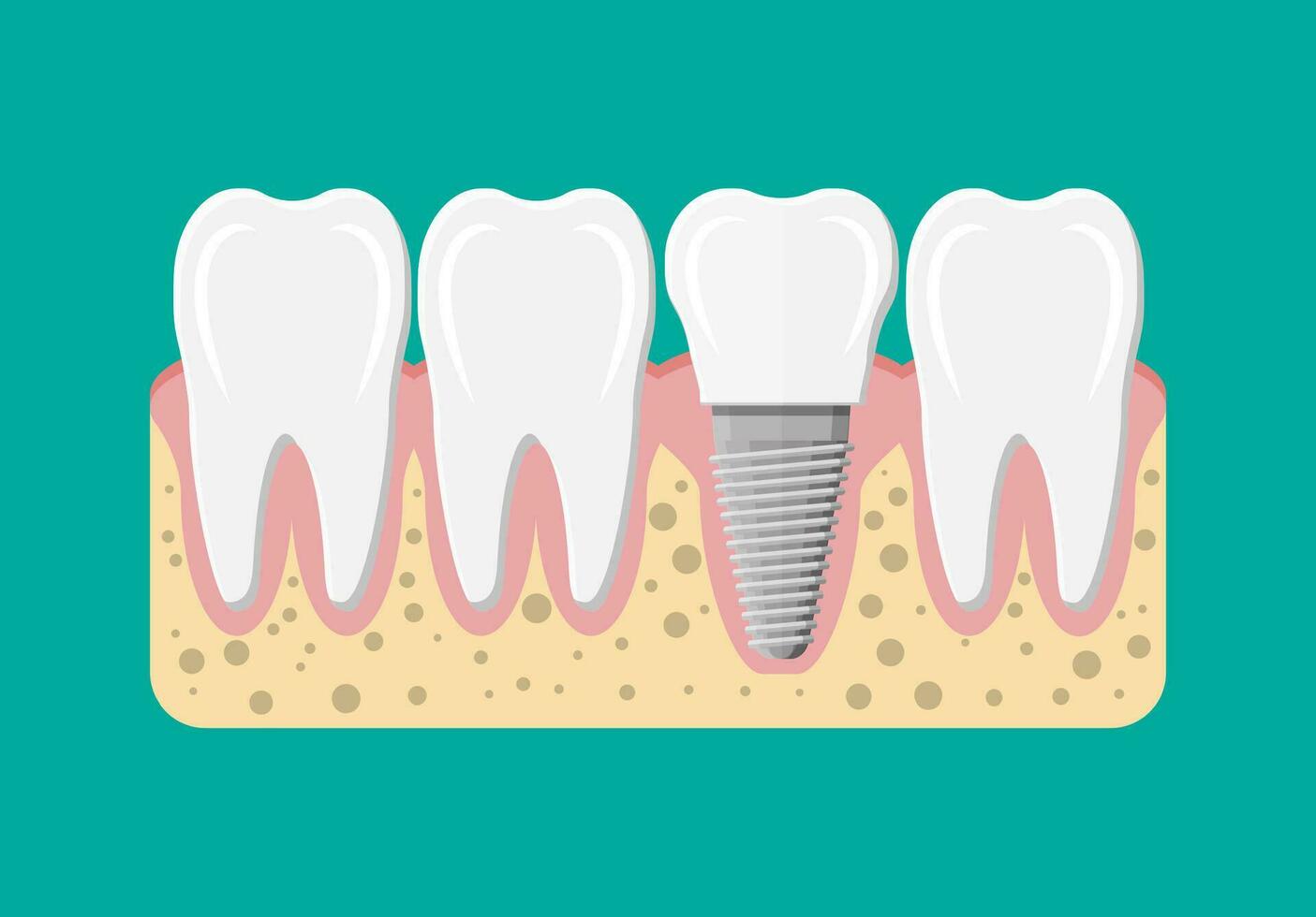 Tooth restoration. Dental implant. Dental prostheses. Artificial teeth with steel pin. Oral care, stomatology and dentistry. Vector illustration in flat style