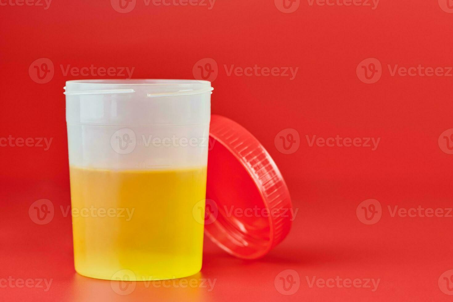 Urinalysis for urolithiasis in container photo