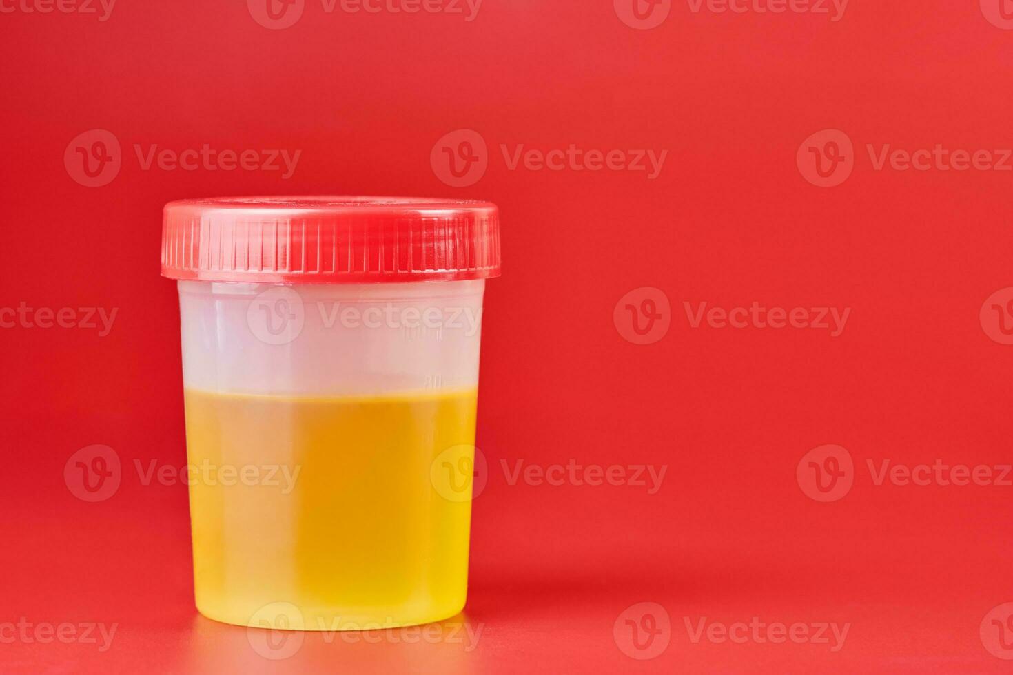 Urinalysis for urolithiasis in container photo