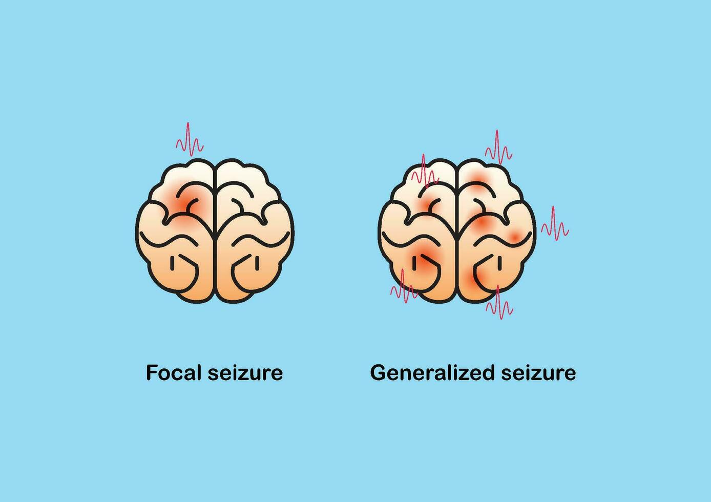 Illustration of seizure types demonstrating by onset and brain waves. vector