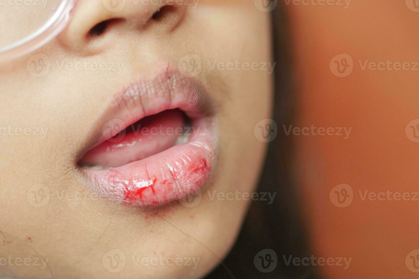 close up of dry lip of a child photo