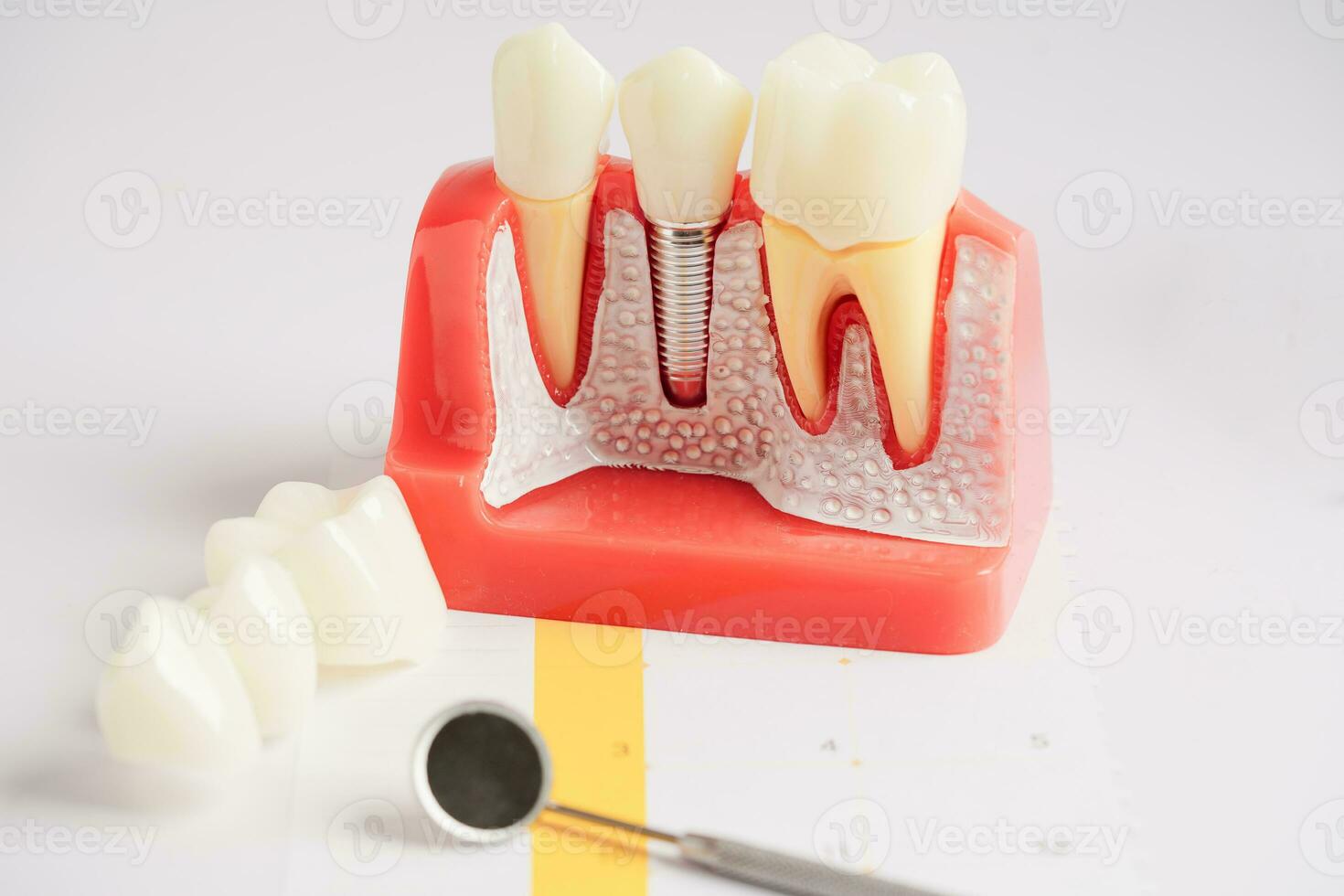 Dental implant, artificial tooth roots into jaw, root canal of dental treatment, gum disease, teeth model for dentist studying about dentistry. photo