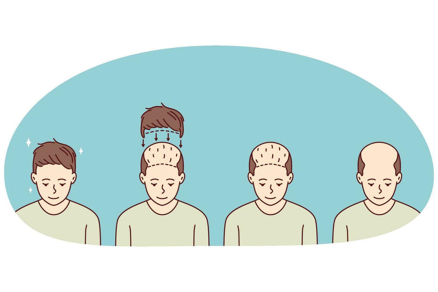 etapas en hombre pelo trasplante. tratamiento de calvicie y alopecia. conjunto de masculino paciente folicular unidad extracción. vector ilustración.