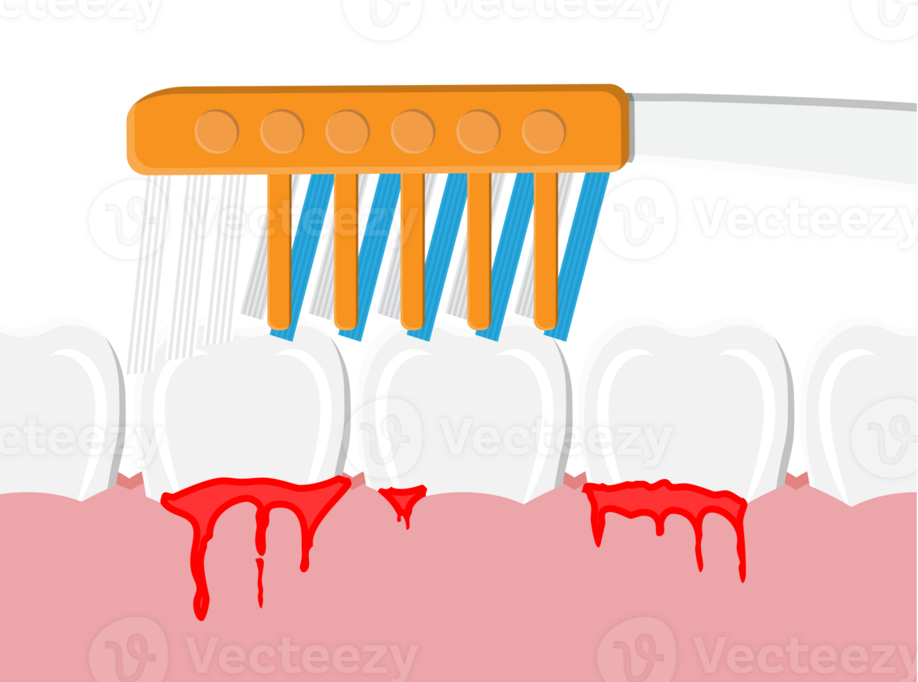 Periodontal disease, bleeding gums png