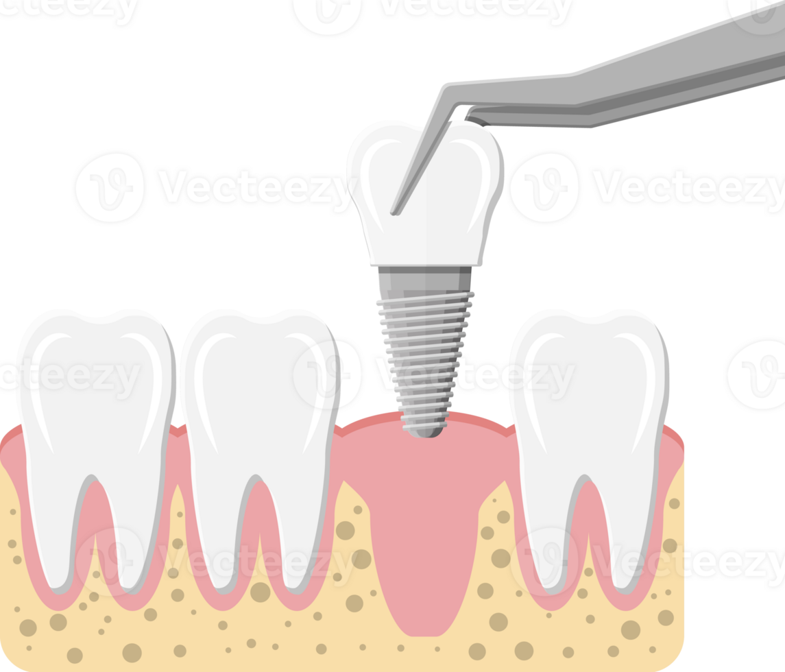 tand restauratie, tandheelkundig implantaat png