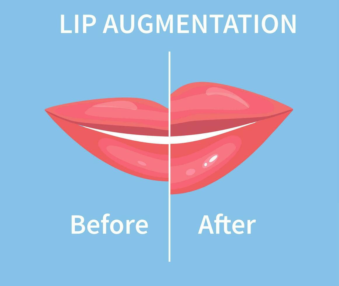 Lip Augmentation. Before and after lip filler injections. Hyaluronic Acid injections. Vector illustration in flat style