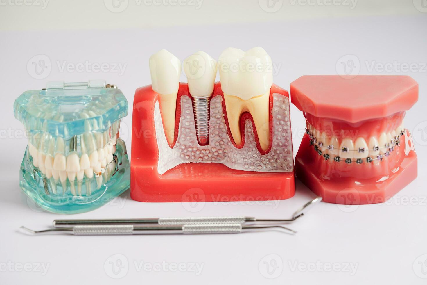 Dental implant, artificial tooth roots into jaw, root canal of dental treatment, gum disease, teeth model for dentist studying about dentistry. photo