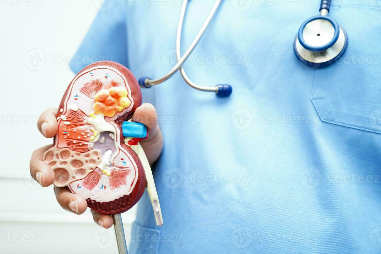 Chronic kidney disease, doctor with model for treatment urinary system, urology, Estimated glomerular filtration rate eGFR. photo