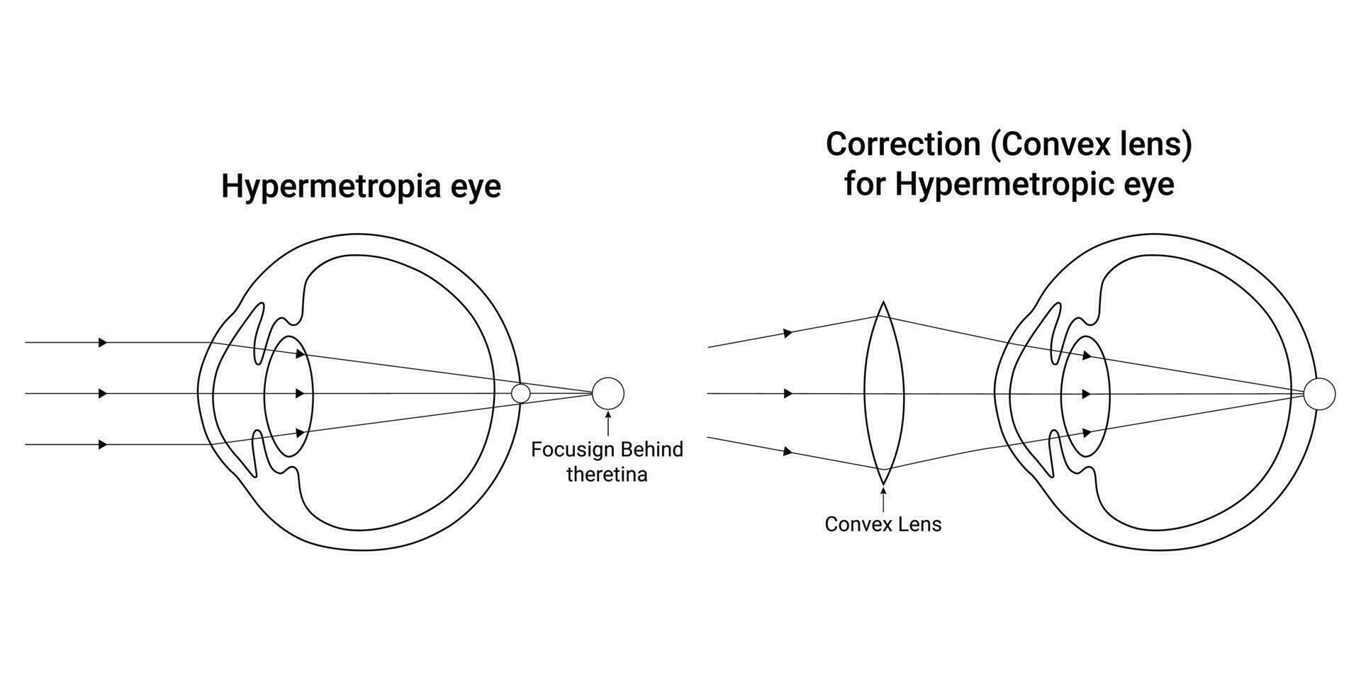 hipermetropía ojo Ciencias diseño vector ilustración diagrama