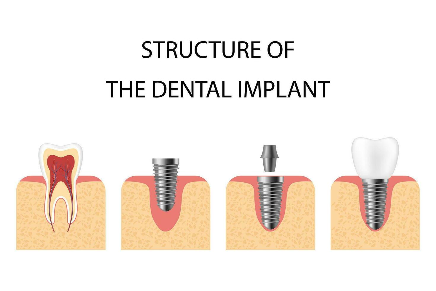 dental implante. tornillo prótesis, ortodoncia dental implantación vector