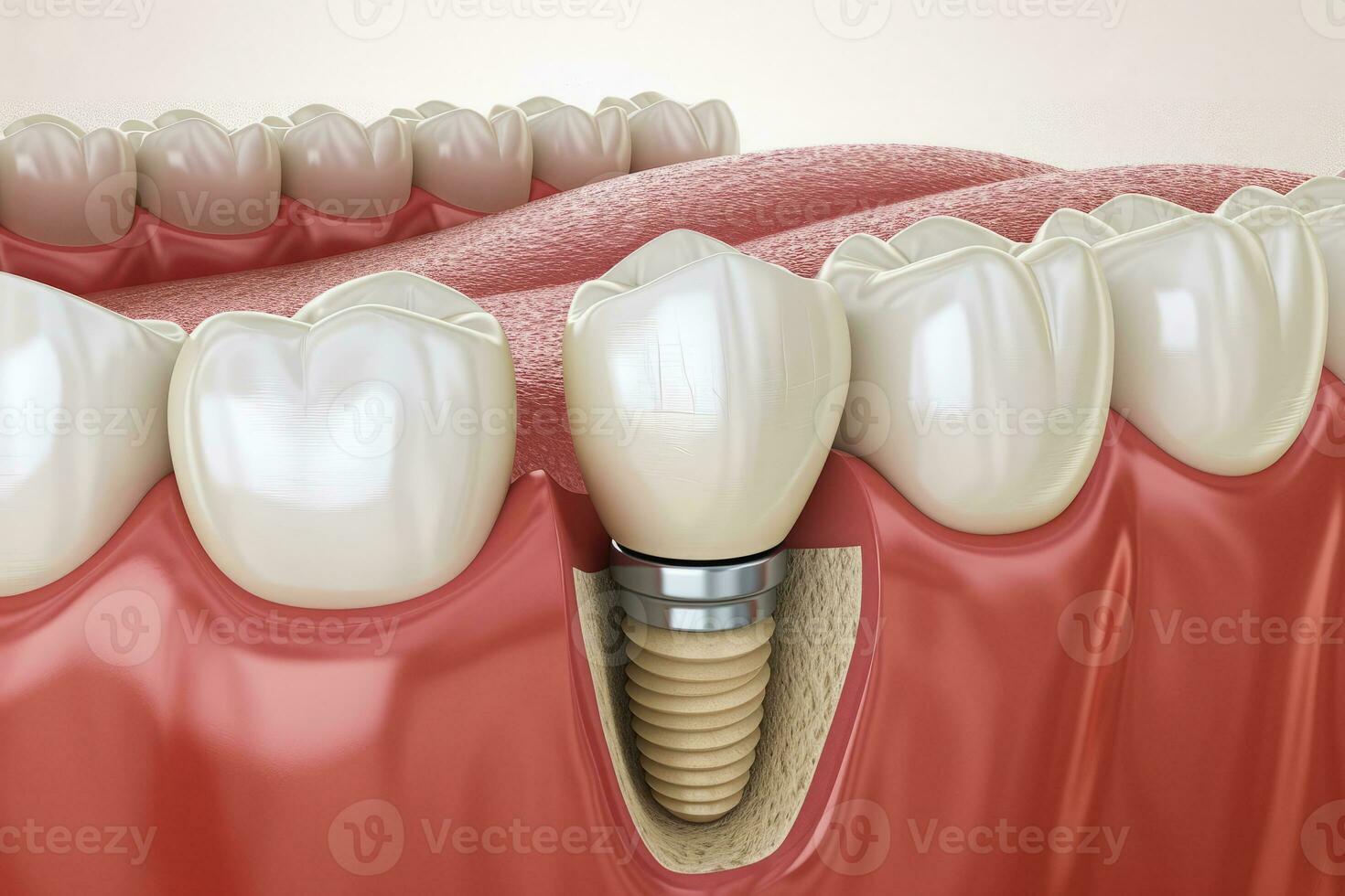 ai generado diente implante instalado en mandíbula. dental cirugía foto