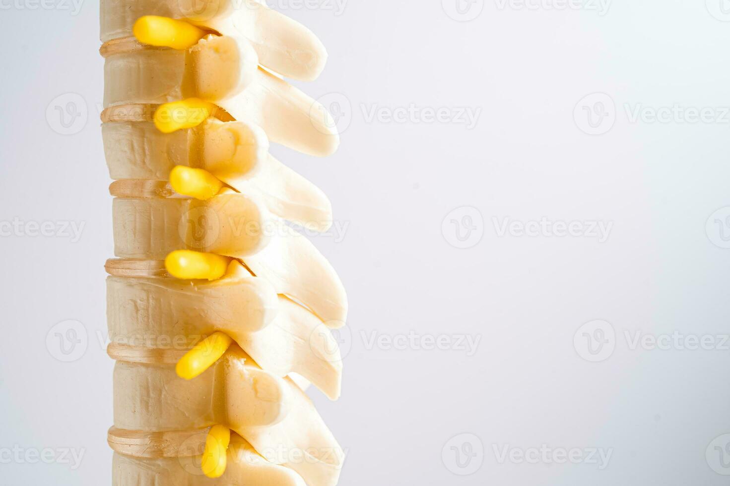 Lumbar spine displaced herniated disc fragment, spinal nerve and bone. Model for treatment medical in the orthopedic department. photo