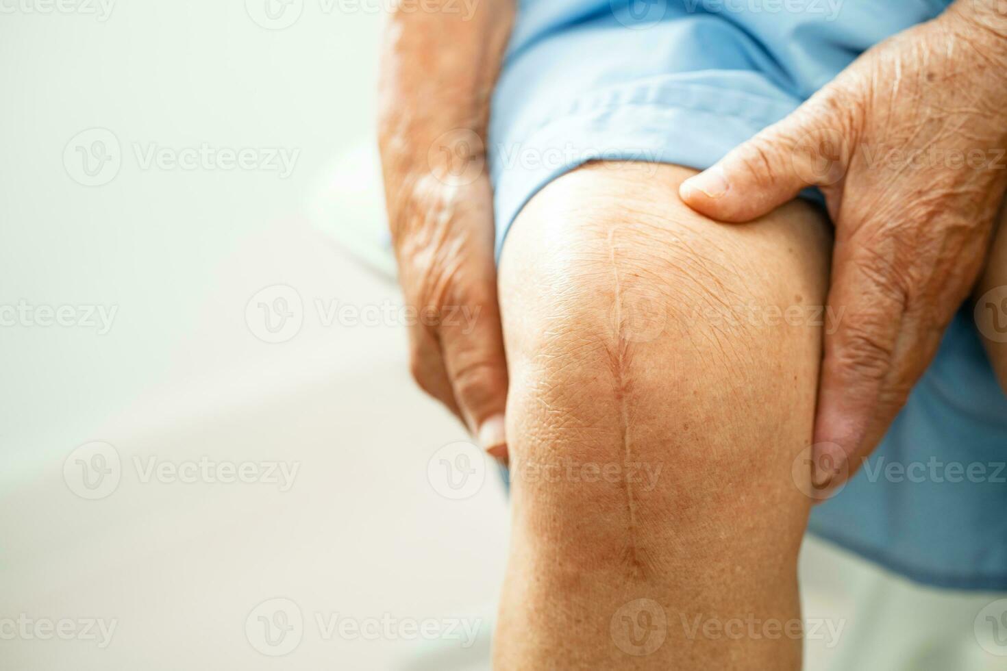 Asian elderly woman patient show her scars surgical total knee joint replacement Suture wound surgery arthroplasty on bed in hospital. photo