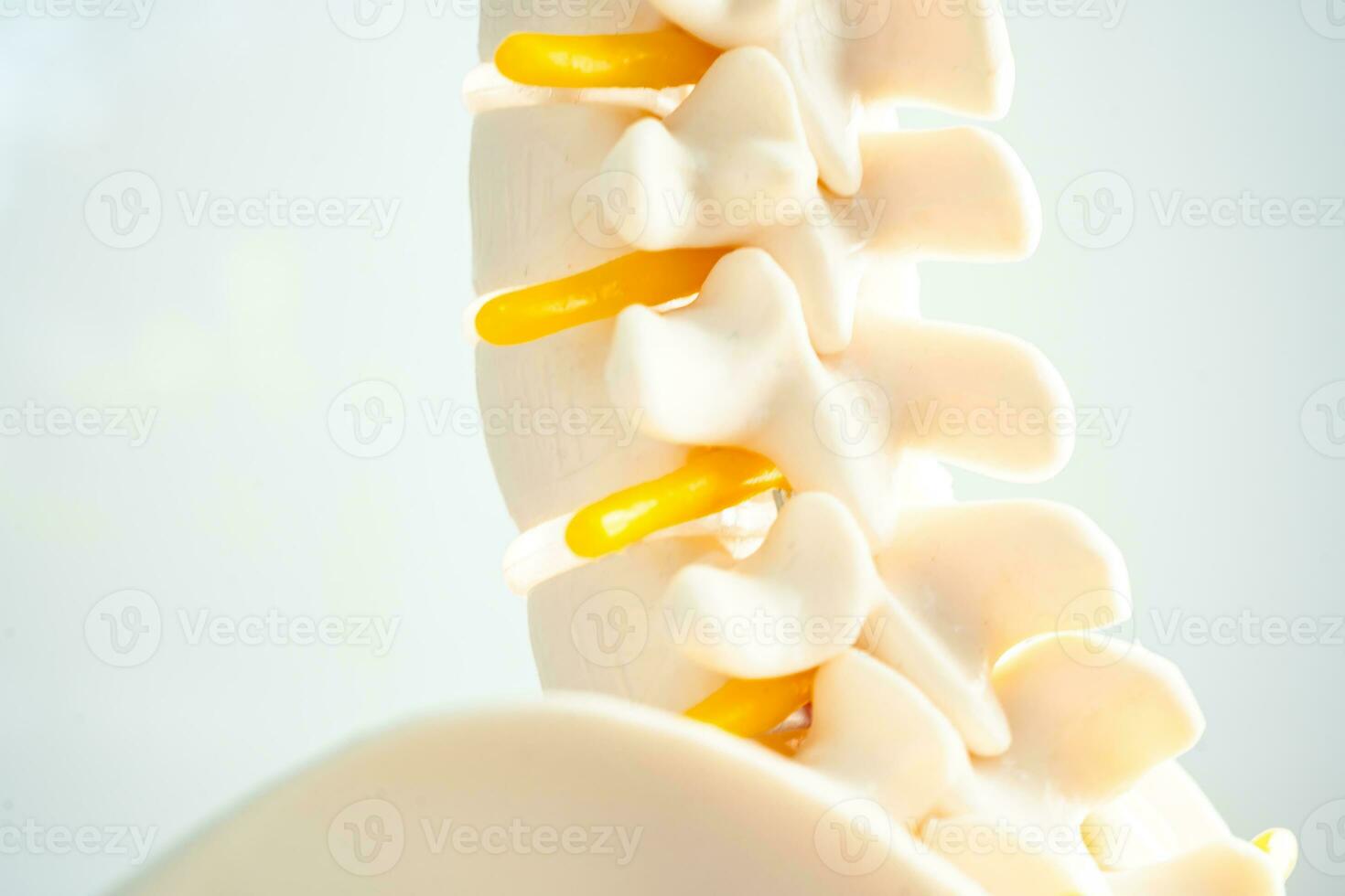 Lumbar spine displaced herniated disc fragment, spinal nerve and bone. Model for treatment medical in the orthopedic department. photo