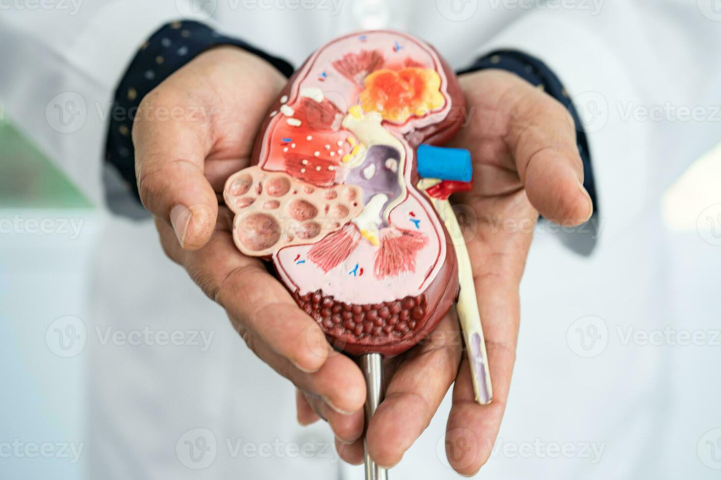 Kidney disease, Chronic kidney disease ckd, Doctor hold model to study and treat in hospital. photo