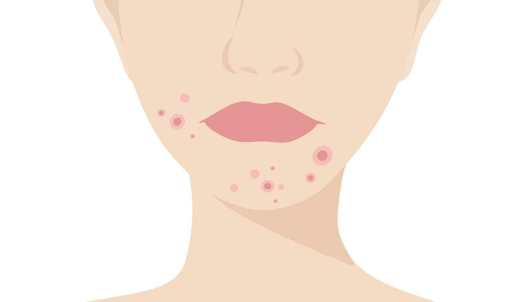 Young woman face with skin acne, pimples, blackheads vector illustration. Acne skin face problem concept