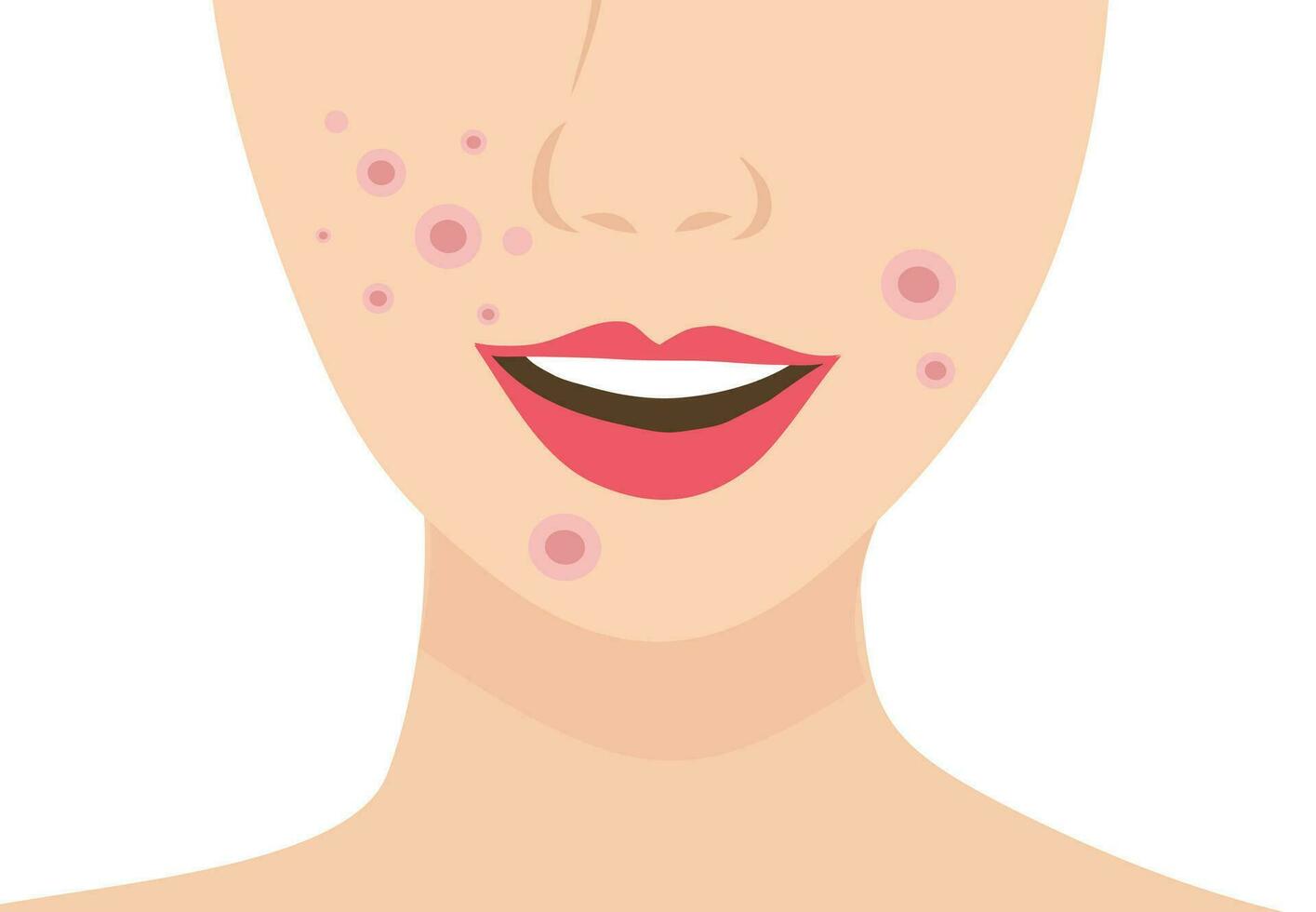 Young woman face with skin acne, pimples, blackheads vector illustration. Acne skin face problem