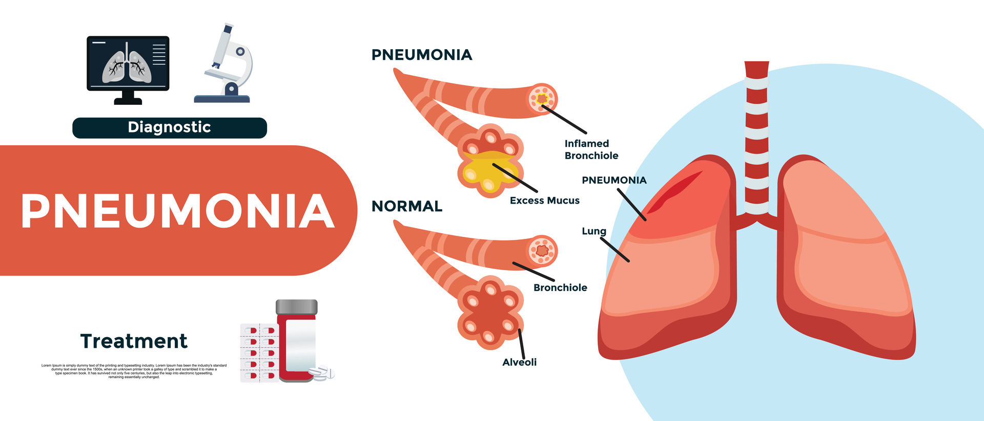 Pneumonia. Difference and Comparison of healthy lungs bronchioles and