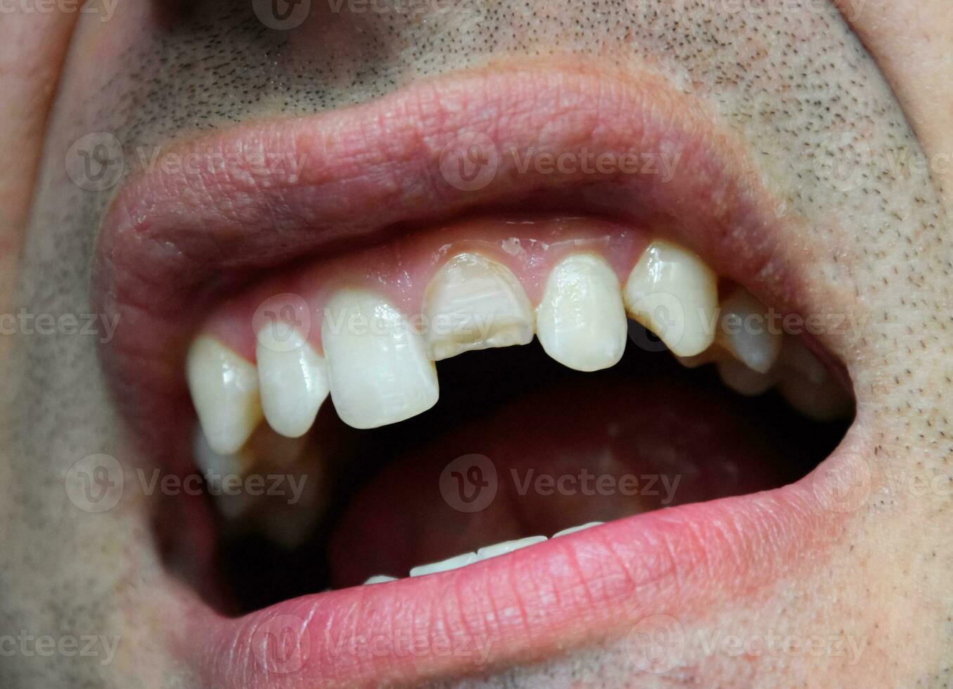 Broken tooth. Broken upper incisor in a man mouth. photo
