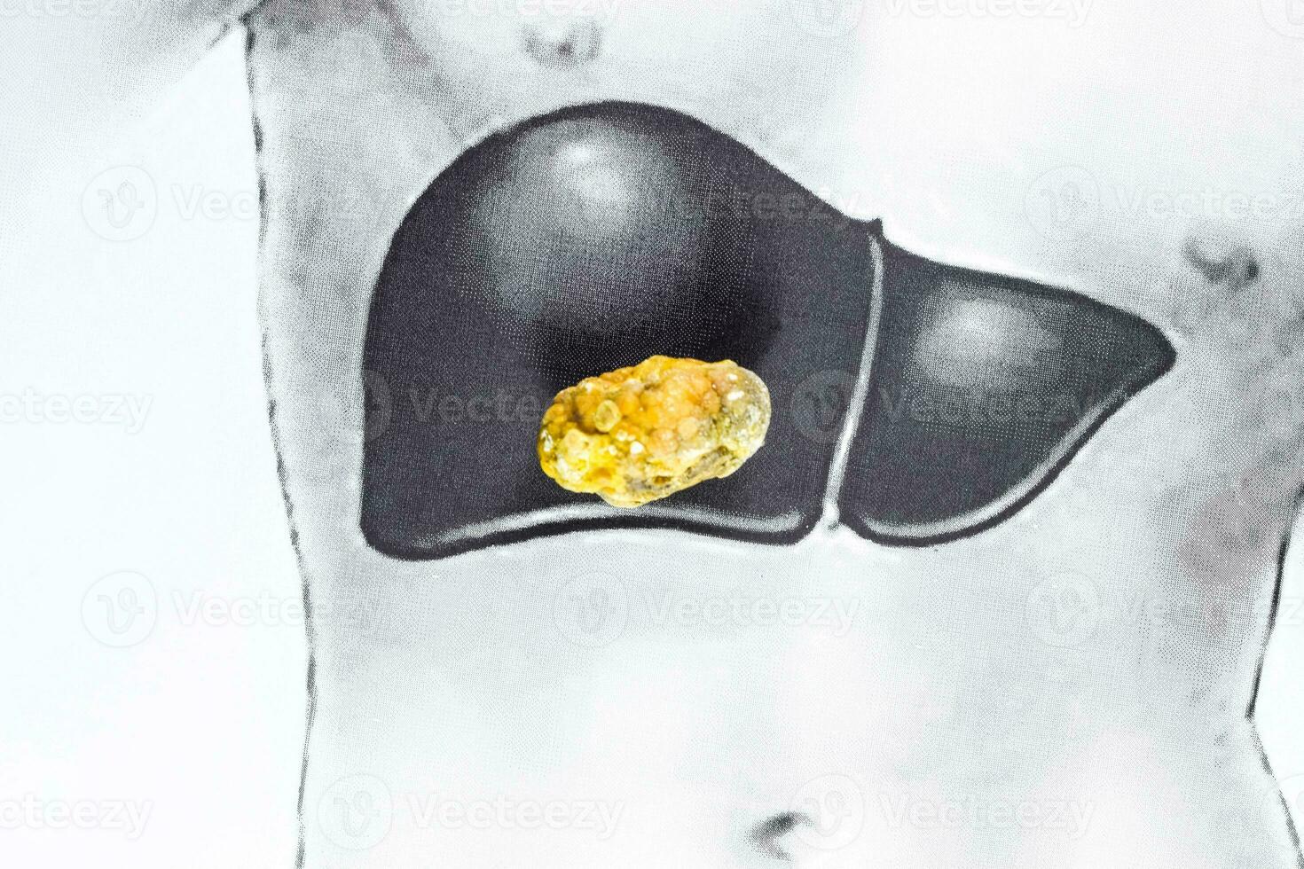 stone in the liver, schematic image, a large gallstone, the result of gallstones. photo