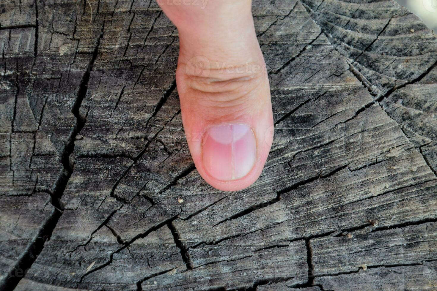 Forked nail on the thumb. Dilation of the nail, traumatic pathology. The nail is divided in half photo