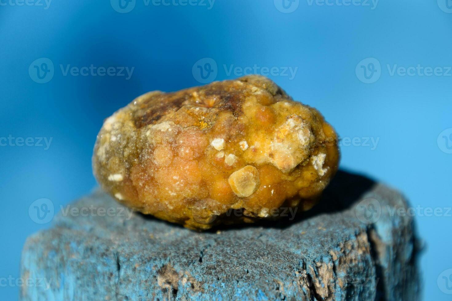 Gall bladder stone. Calculus of heterogeneous composition photo
