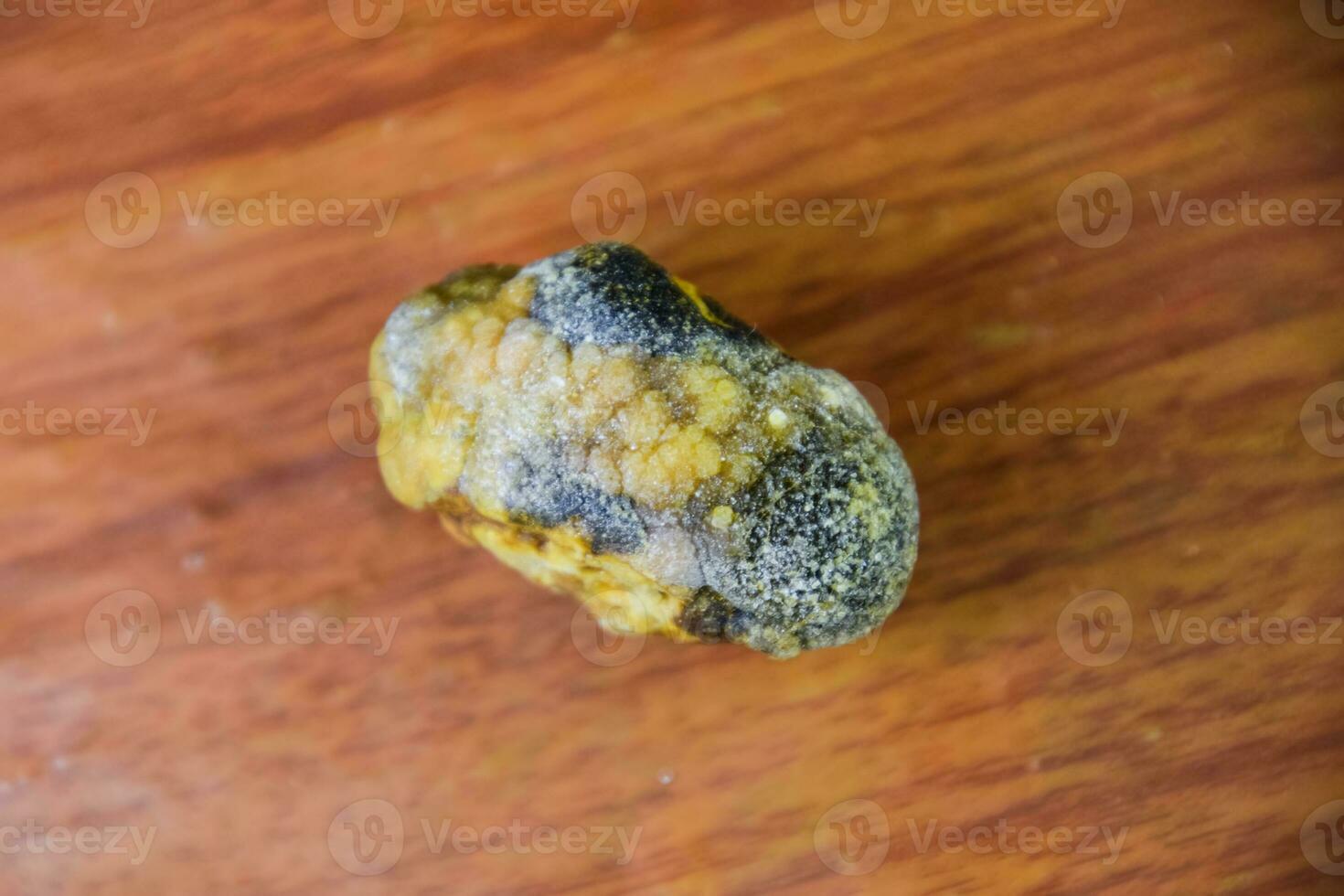 Large gallstone, Gall bladder stone. The result of gallstones photo