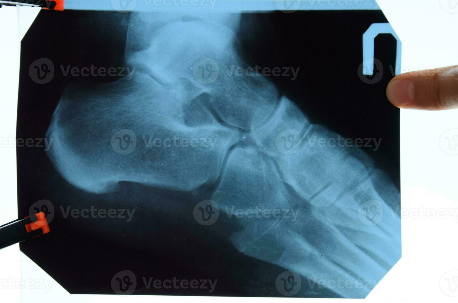 X-ray of feet and heel bones. X ray picture of bones. photo