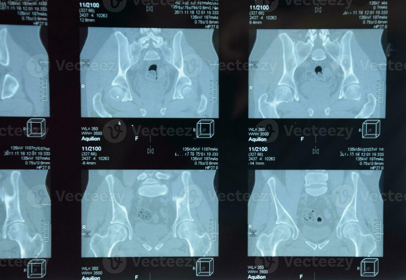 MRI sacroiliac articulation. Study of ankylosing spondyloarthritis patient. photo