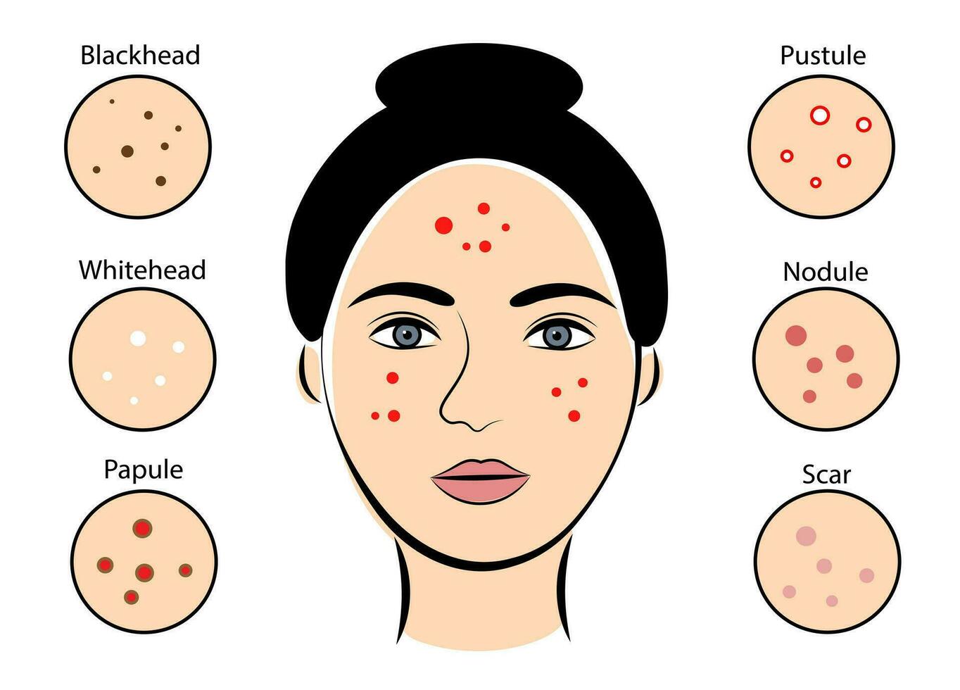 Girl with acne on white background vector