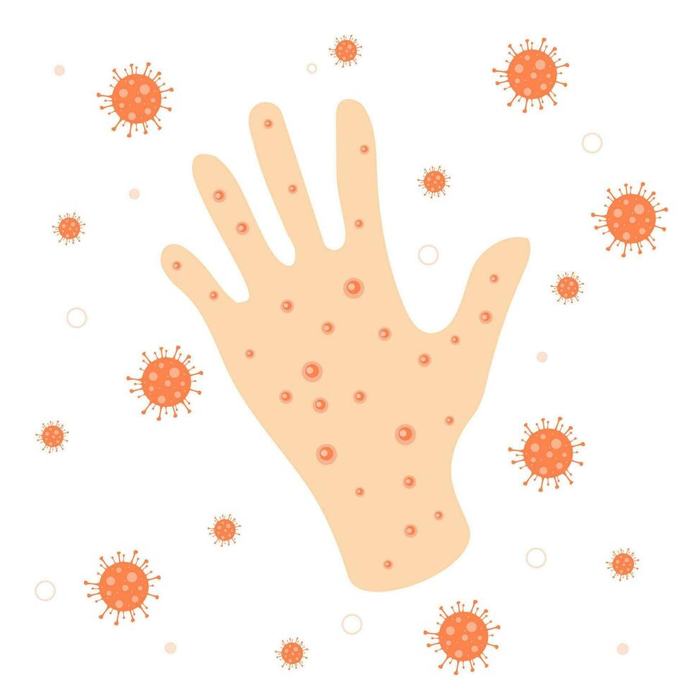 Acne on the hand with virus isolated on white background vector
