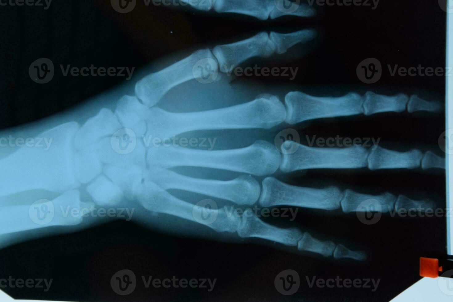 X ray of the hands, a picture of the bones of the hands on the x-ray. photo