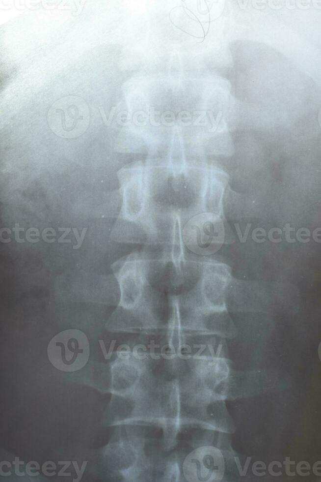 X ray of the lumbar spine, spine on x-ray photo