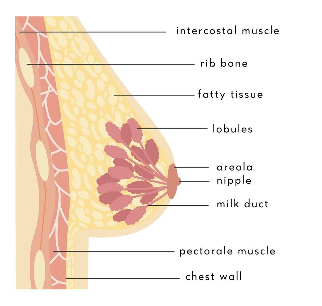 médico infografía cruzar sección de hembra pecho con absceso. información tarjeta con pus lleno bulto. anatomía de mujer cofre con infección. inflamación de mamario glándula. dolor. vector ilustración.