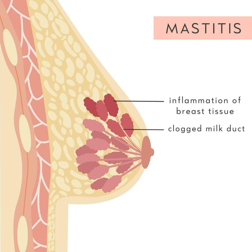 Mastitis. Medical Infographic Cross Section of Female Breast. Information card with pus filled lump. Anatomy of Woman Chest with Infection. Inflammation of Mammary gland. Pain. Vector illustration.