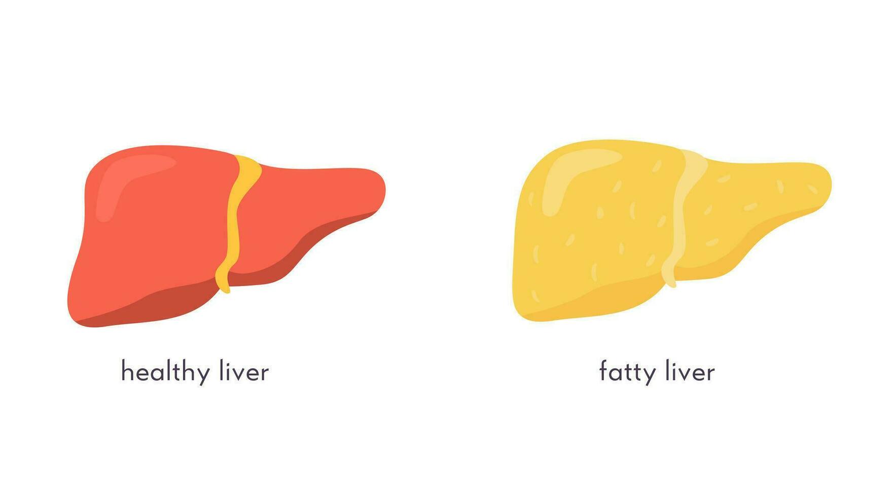 etapas de no alcohólico hígado daño. saludable, graso, esteatosis, nash, fibrosis, cirrosis, cáncer. médico infografía de hígado enfermedad. vector bandera en plano dibujos animados estilo en blanco antecedentes.