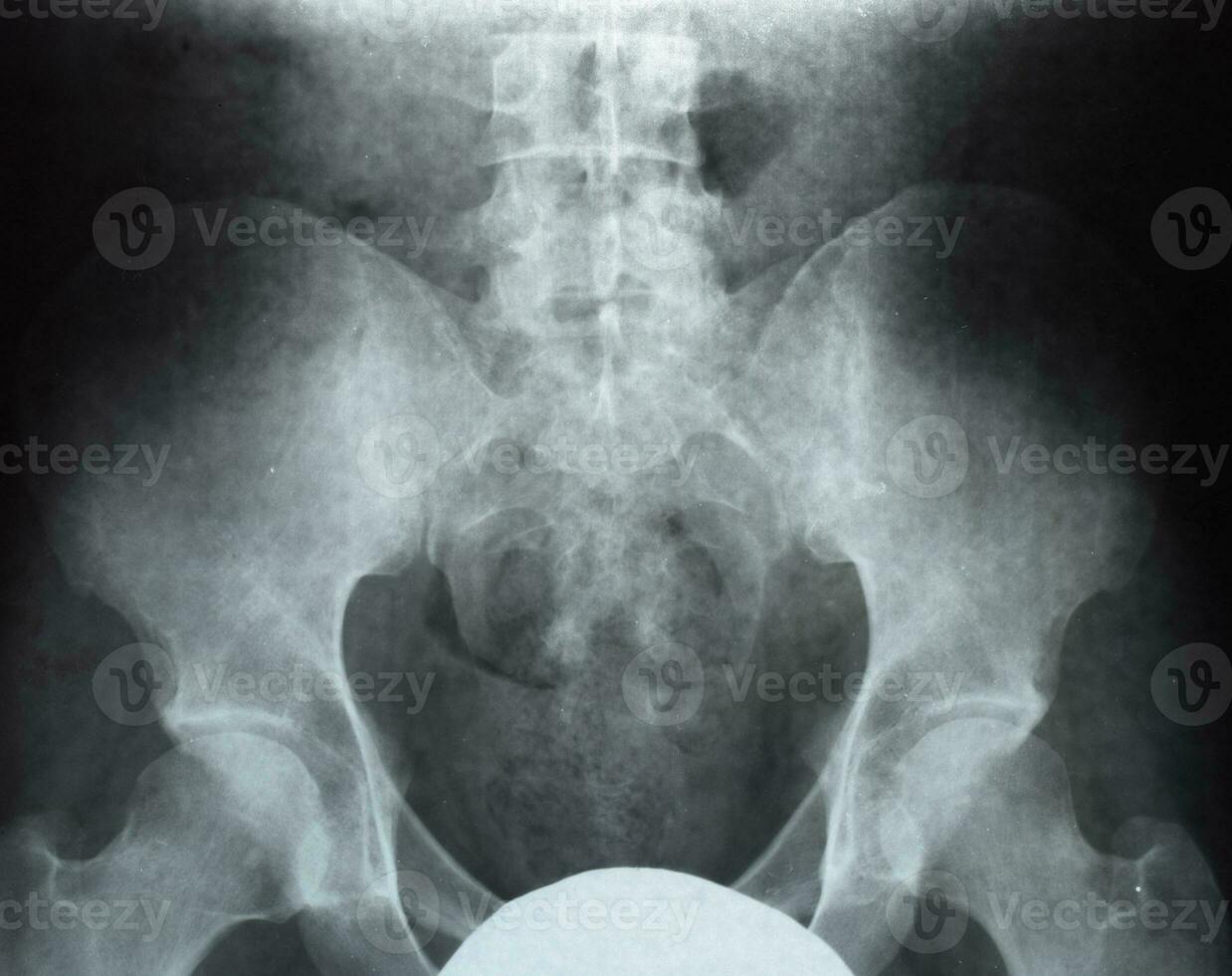 X-ray of the pelvis and sacrum. X-ray photo
