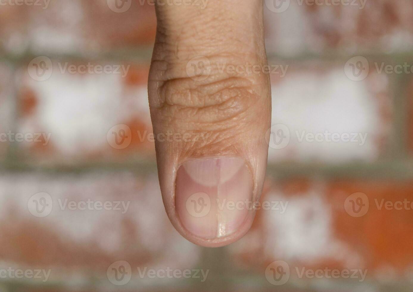 Forked nail on the thumb. Dilation of the nail, traumatic pathology. The nail is divided in half photo