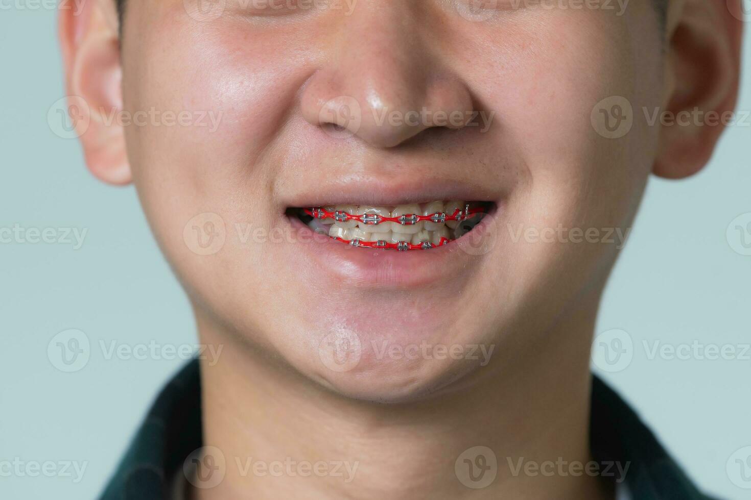 Asian man braces. Teeth braces on the white teeth of man to equalize the teeth. Bracket system in smiling mouth, close up photo teeth, macro shot, dentist health concept.