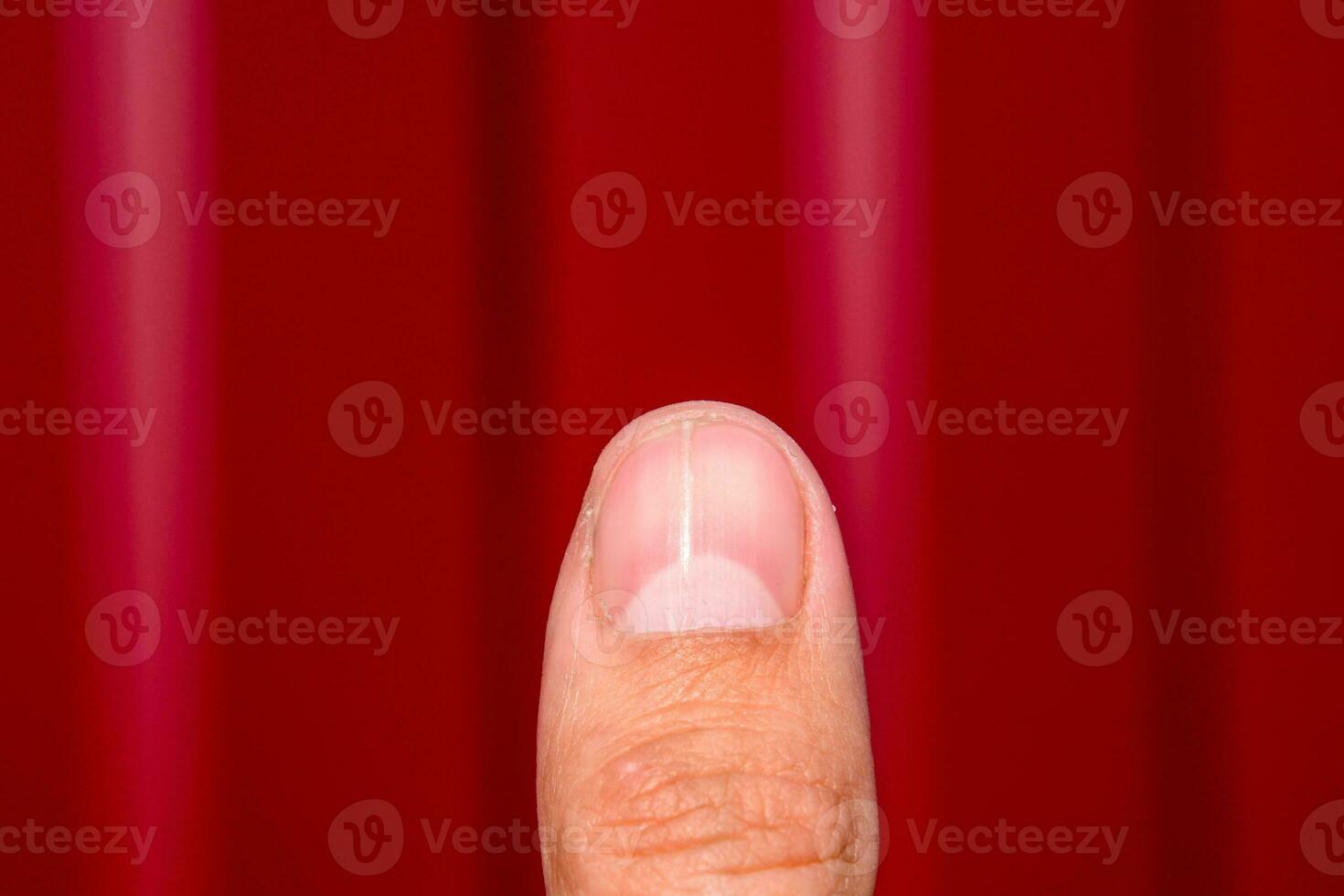 Forked nail on the thumb. Dilation of the nail, traumatic pathology. The nail is divided in half photo