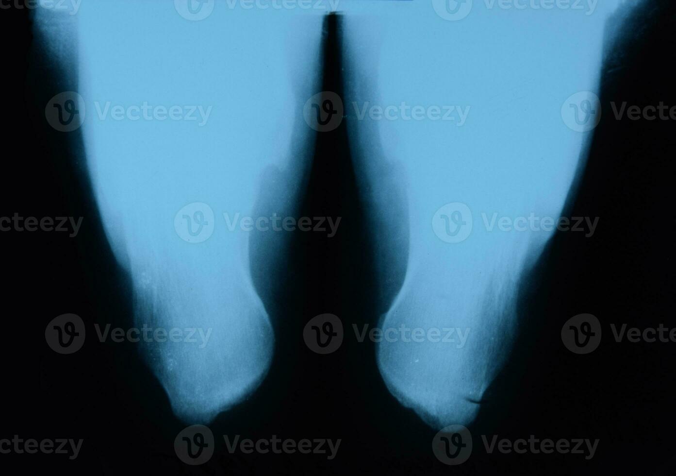 X-ray of feet and heel bones. X ray picture of bones. photo